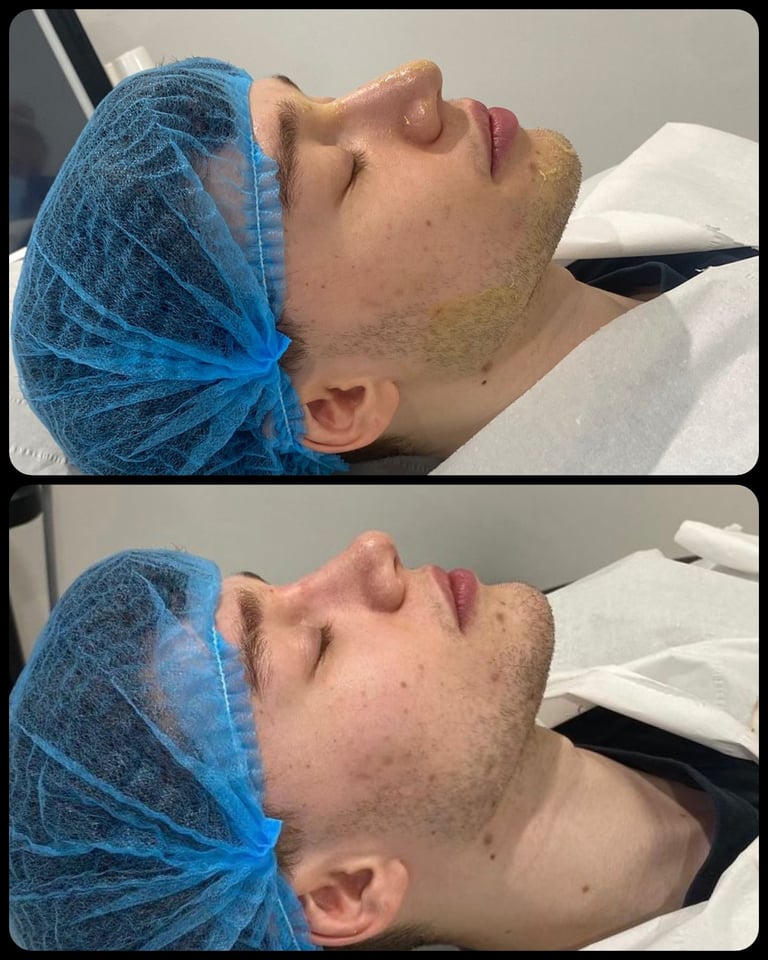 Before and after cosmetic procedure showing profile view of male patients face with blue surgical head covering